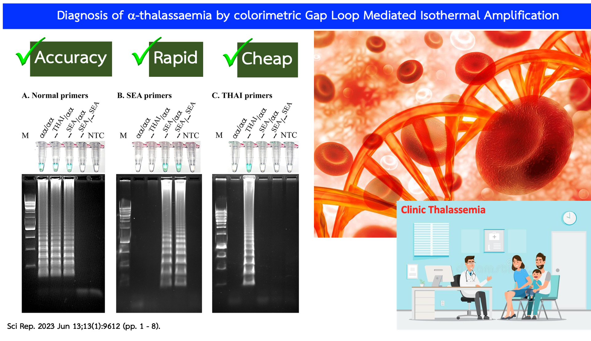 การตรวจวินิจฉัยโรคอัลฟ่าธาลัสซีเมียด้วยเทคนิคการติดตามด้วยสีแกพลูพเมดิเอเทตไอโซเทอร์ มอลแอพพลิฟิเคชั่น